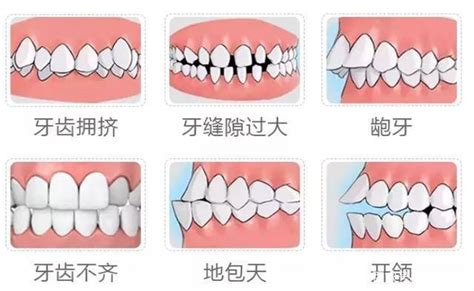 门牙大|门牙很大怎么办？